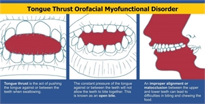 Tongue thrust is orofacial myofunctional disorder