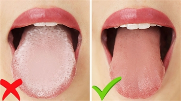 How to get rid of plaque on the tongue