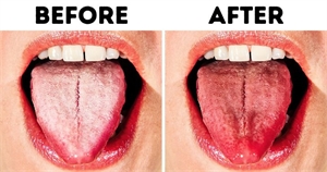 Clean the plaque of your tongue to protect teeth and soft tissues. Scraped tongue plaque - before and after