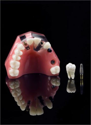 dental- implants