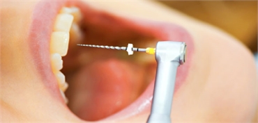 Root Canal Treatment in Seville Victoria