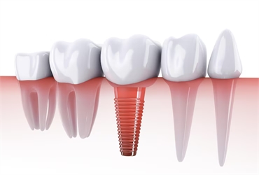 Why Dental Implants are the Best Solution for Missing Teeth