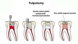 What is pulpotomy?