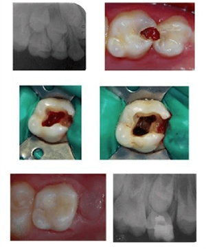 Full case of pulpotomy on a baby tooth with step by step pictures and x-rays
