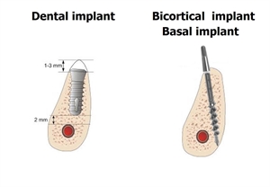 What are Bicortical dental implants or Basal implants