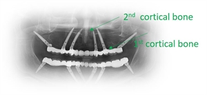 Bicortical dental implants, also known as basal implants, achieve primary stability withing 2 cortical bone sections