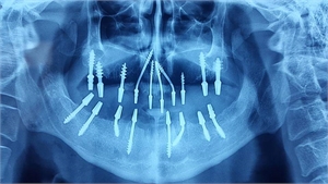 OPG with bicortical basal implants