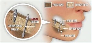What is the difference between normal dental implant and basal (bicortical) dental implant