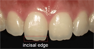Translucent incisal edges of anterior front teeth