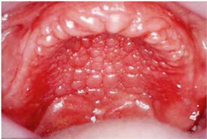 Denture stomatitis