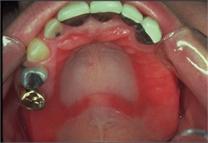 Denture stomatitis inflammation