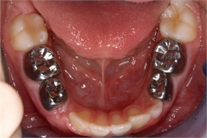 9-year-old child with metal crowns