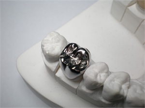 Stainless Steel Dental Crown