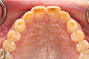 Wear facets across the whole upper dental arch