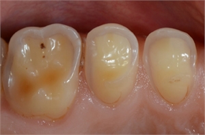 Wear facets on premolars and molar