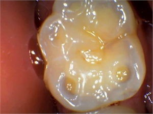 Wear facets caused by bruxing on the chewing surface of molar