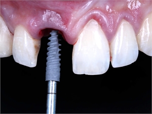 Changing the Dental Implant Landscape: The Impact of Immediate Loading