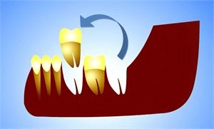How to do tooth autotransplantation and why?