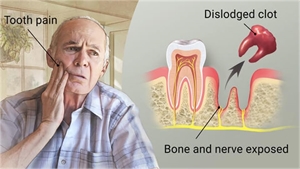 Smoking after tooth extraction can delay healing and cause infection called dry socket