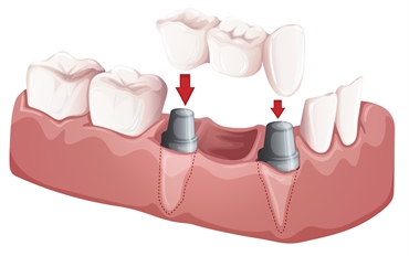 Exploring the Advantages of Tooth Bridges Compared to Dental Implants