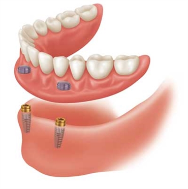 The Benefits and drawbacks Of Snap On Dentures