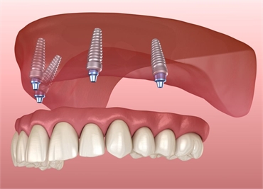 Dental Implant Steps What to Expect During Your Procedure