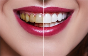 What Are Dental Veneers Everything to Know About Cosmetic Dentistry
