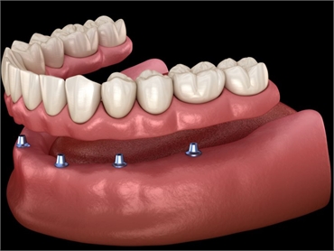 How Do Implant Dentures Work