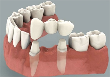 Common Dental Bridge Problems You Should Not Overlook
