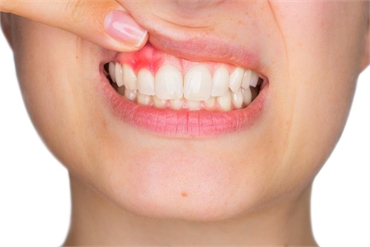 What Are the Symptoms of Periodontal Disease