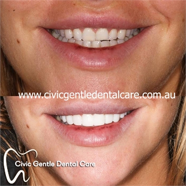 Canberra Dental Crowns