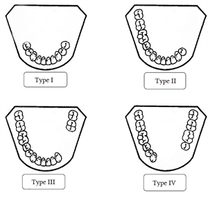 Kennedy classification for edentulous dentition
