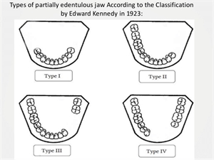 Types of partially edentulous jaw according to the classification of Edward Kennedy in 1923