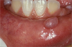 Mucocele is fluid-filled blister caused by blockage of mucus
