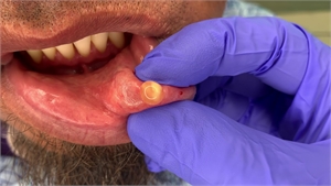 Mucocele on the inside of the lower lip