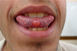 Mucocele mucous cyst on the bottom of the tongue
