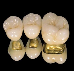 What is a porcelain fused to gold (PFG) dental crown?