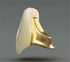 Porcelain Fused to Gold Dental Crown