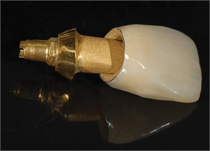 Gold Post Abutment and a PFG Dental Crown