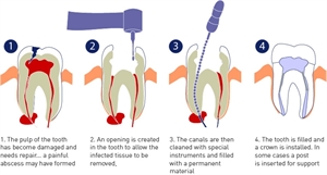Root Canal Treatment in Gurgaon