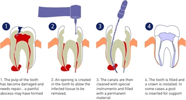 How can root canal therapy be used to treat an infected tooth