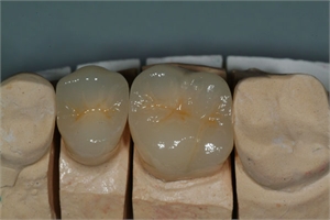 PFZ Dental Crowns