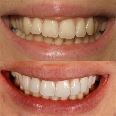 Perfecting Smiles with Cosmetic Bonding in London
