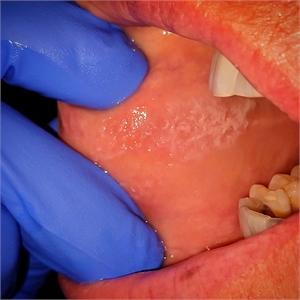 White scars on the inside of the cheek caused by the teeth - cheek biting