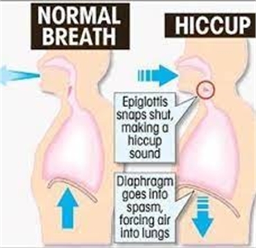 What causes hiccups?