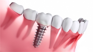 Dental Implant Process and Healing Stages