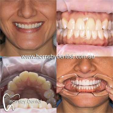 Teeth Whitening Hornsby