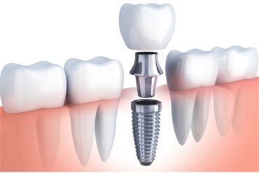 Five Helpful Tips to Care for Your Dental Implant