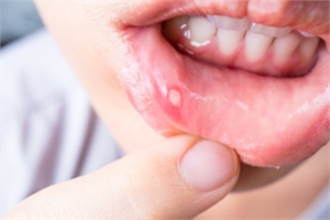 White Bump on the Inside of Lip: Causes, Symptoms, and Treatment