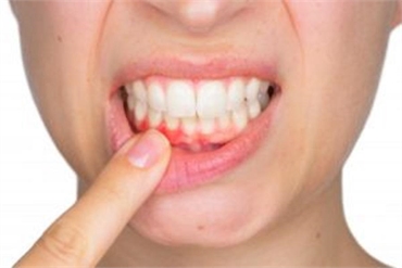 Preventing and Treating Gum Disease What You Need to Know